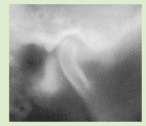 TMJ Diagnosis4